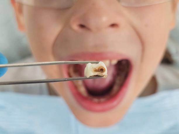 Best Same-Day Emergency Dental Services in Connersville, IN
